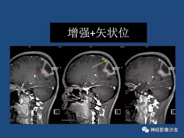 【病例】右顶枕叶髓母细胞瘤一例CT及MR影像讨论 【病例】右顶枕叶髓母细胞瘤一例CT及MR影像讨论
