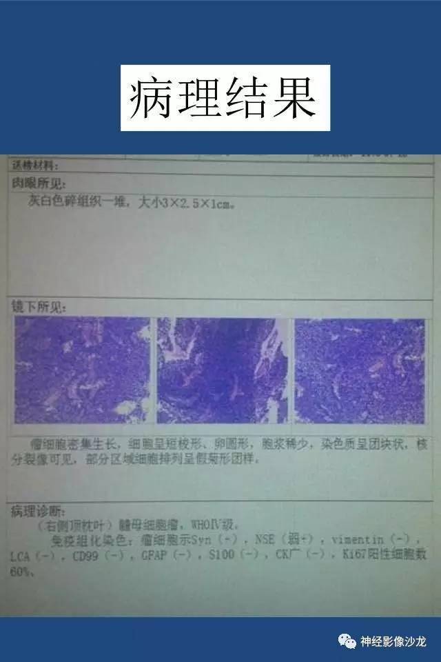 【病例】右顶枕叶髓母细胞瘤一例CT及MR影像讨论 【病例】右顶枕叶髓母细胞瘤一例CT及MR影像讨论