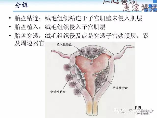 【PPT】产前胎盘植入的MR诊断