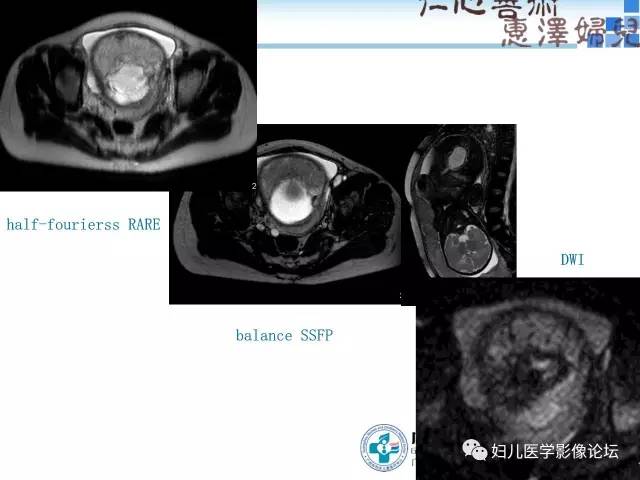 【PPT】产前胎盘植入的MR诊断