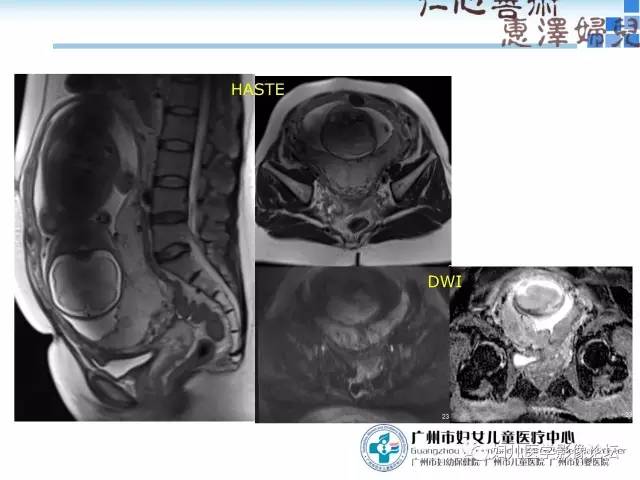 【PPT】产前胎盘植入的MR诊断
