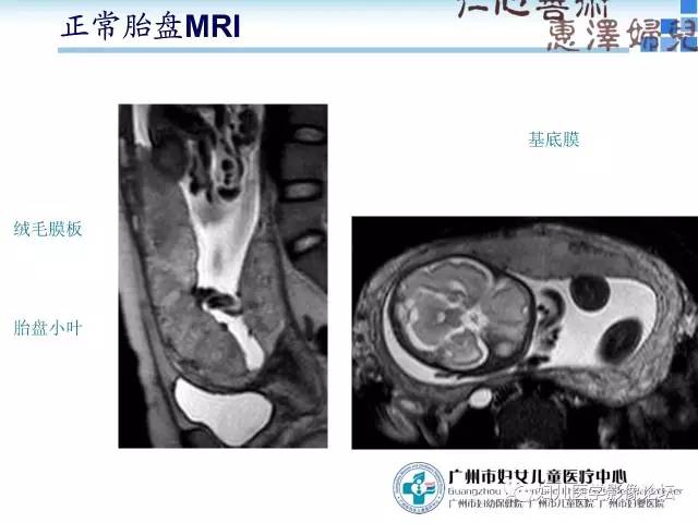 【PPT】产前胎盘植入的MR诊断