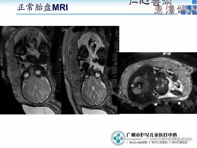 【PPT】产前胎盘植入的MR诊断