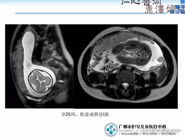 【PPT】产前胎盘植入的MR诊断