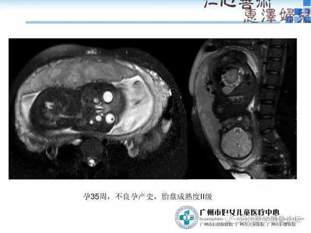 【PPT】产前胎盘植入的MR诊断