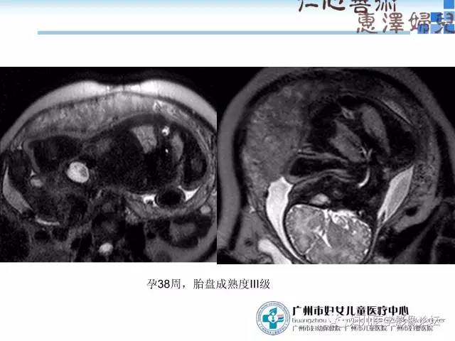 【PPT】产前胎盘植入的MR诊断