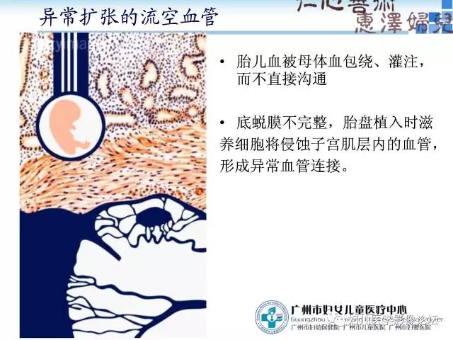 【PPT】产前胎盘植入的MR诊断