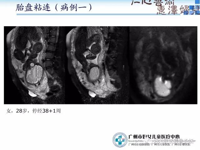 【PPT】产前胎盘植入的MR诊断