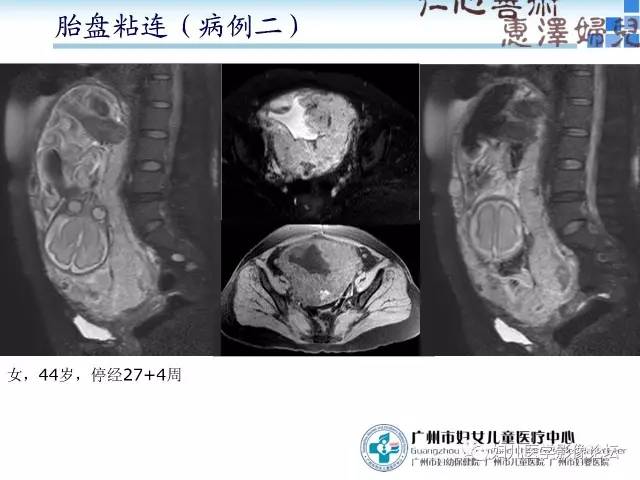 【PPT】产前胎盘植入的MR诊断