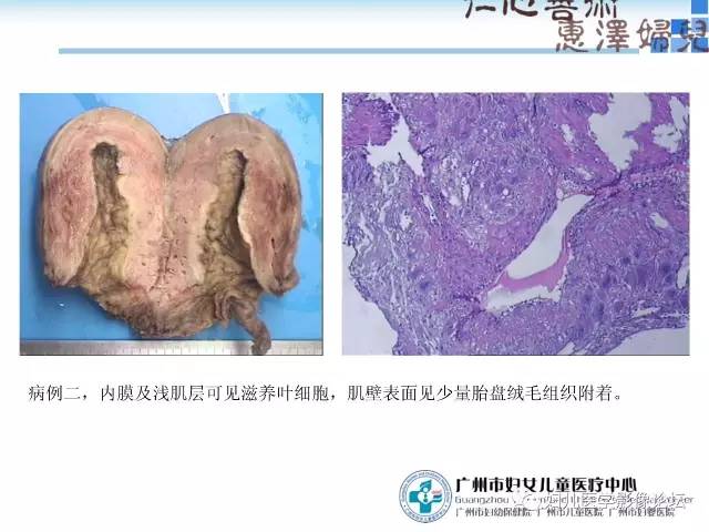 【PPT】产前胎盘植入的MR诊断