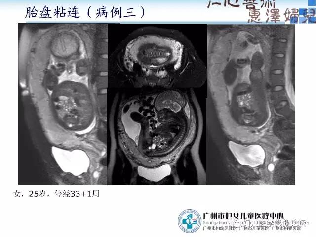 【PPT】产前胎盘植入的MR诊断