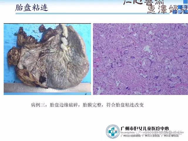 【PPT】产前胎盘植入的MR诊断