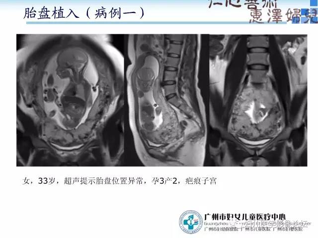 【PPT】产前胎盘植入的MR诊断