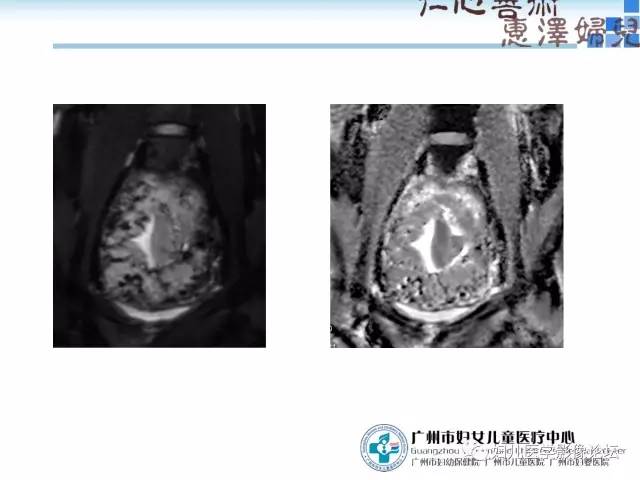 【PPT】产前胎盘植入的MR诊断
