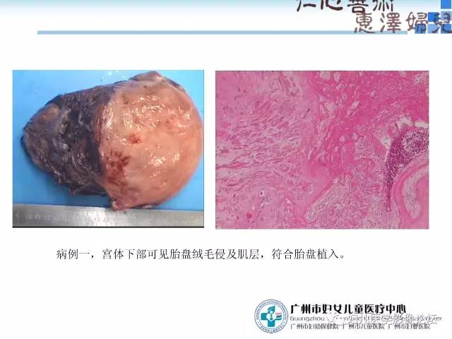 【PPT】产前胎盘植入的MR诊断