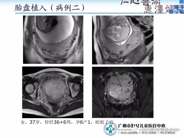 【PPT】产前胎盘植入的MR诊断