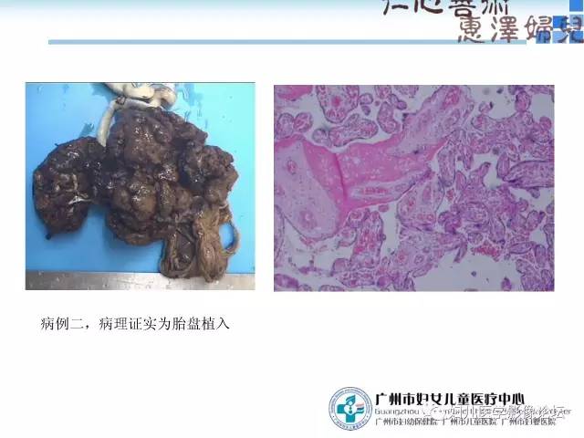 【PPT】产前胎盘植入的MR诊断