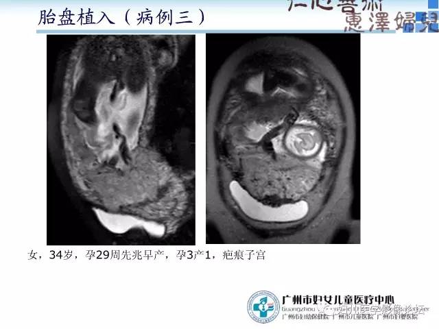 【PPT】产前胎盘植入的MR诊断