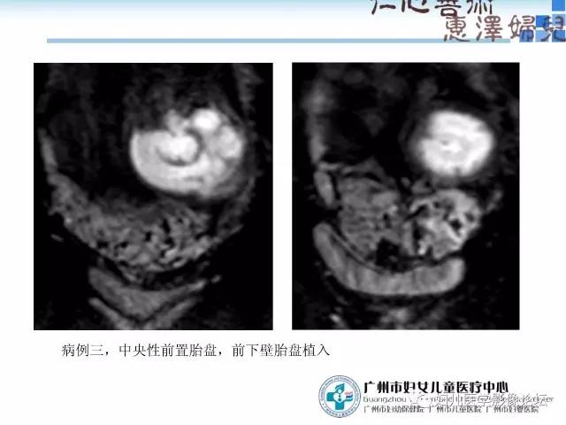 【PPT】产前胎盘植入的MR诊断