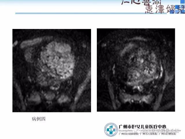 【PPT】产前胎盘植入的MR诊断