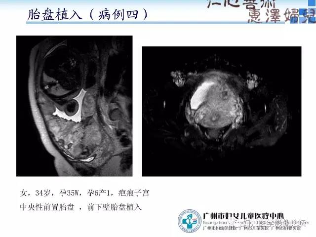 【PPT】产前胎盘植入的MR诊断