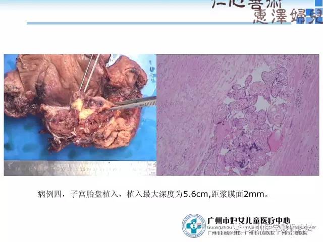 【PPT】产前胎盘植入的MR诊断
