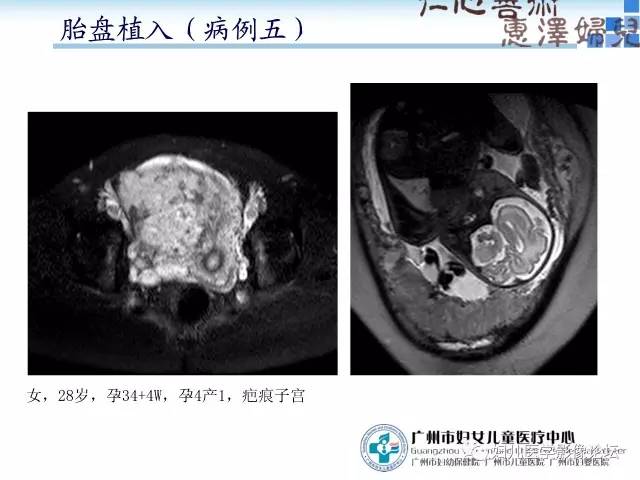 【PPT】产前胎盘植入的MR诊断