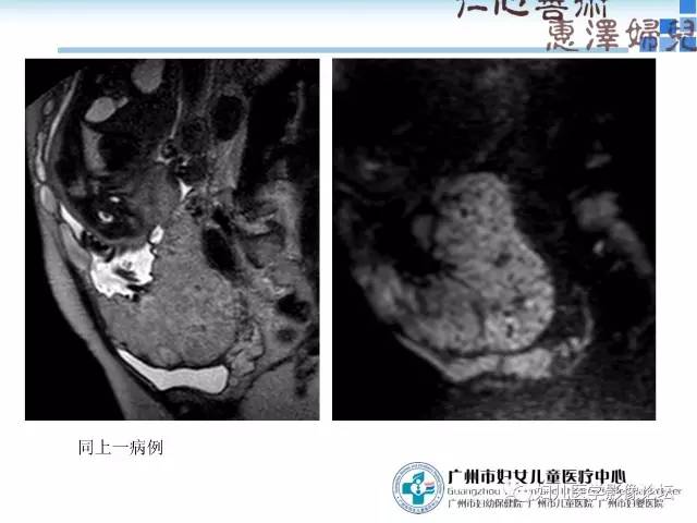 【PPT】产前胎盘植入的MR诊断