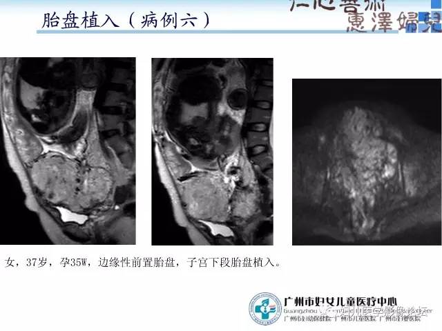 【PPT】产前胎盘植入的MR诊断