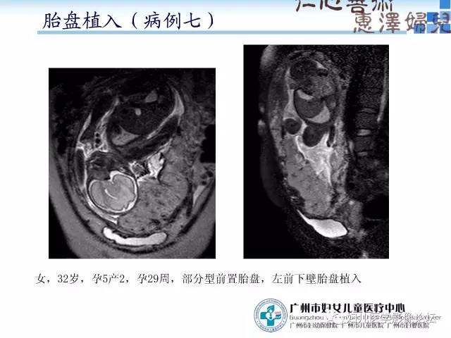 【PPT】产前胎盘植入的MR诊断