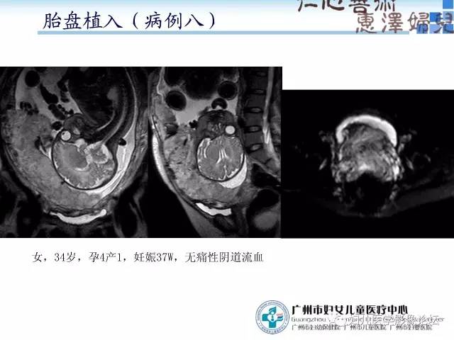 【PPT】产前胎盘植入的MR诊断