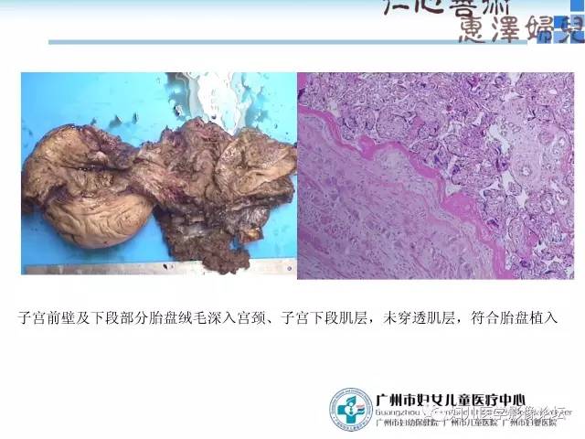 【PPT】产前胎盘植入的MR诊断