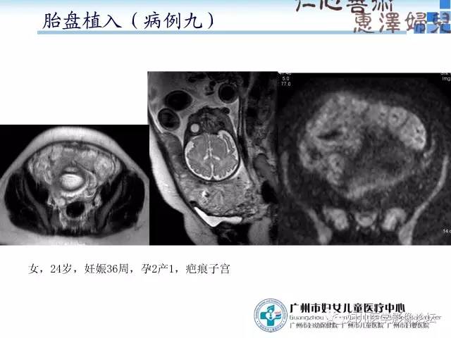 【PPT】产前胎盘植入的MR诊断