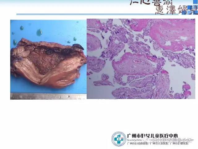 【PPT】产前胎盘植入的MR诊断