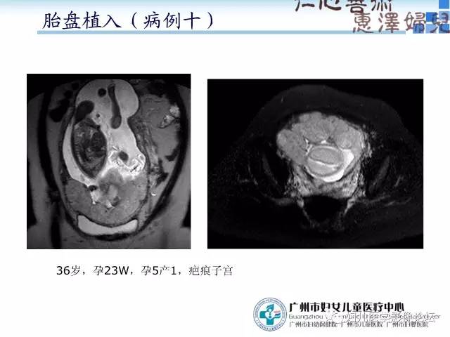 【PPT】产前胎盘植入的MR诊断