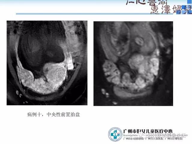 【PPT】产前胎盘植入的MR诊断