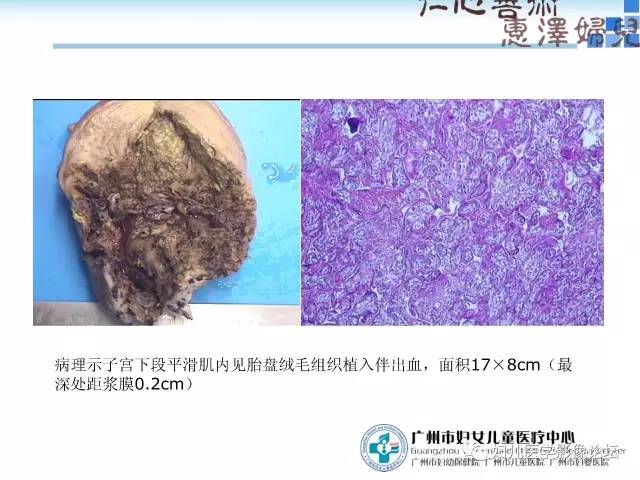 【PPT】产前胎盘植入的MR诊断