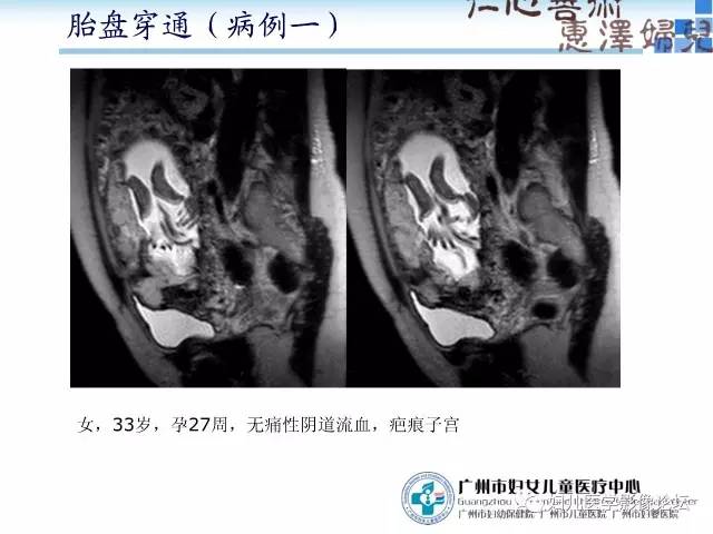 【PPT】产前胎盘植入的MR诊断