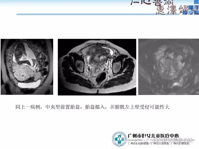 【PPT】产前胎盘植入的MR诊断