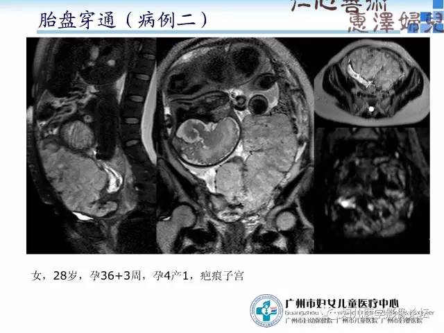【PPT】产前胎盘植入的MR诊断