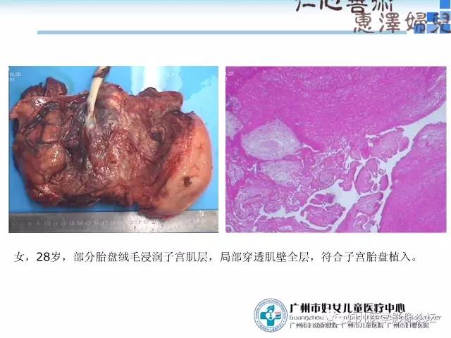 【PPT】产前胎盘植入的MR诊断