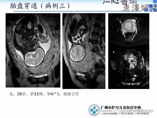【PPT】产前胎盘植入的MR诊断