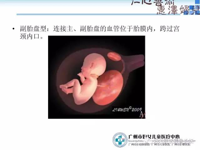 【PPT】产前胎盘植入的MR诊断