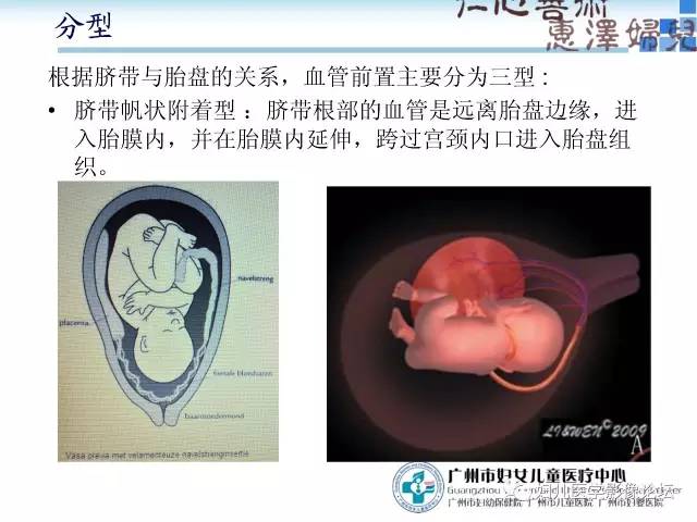 【PPT】产前胎盘植入的MR诊断