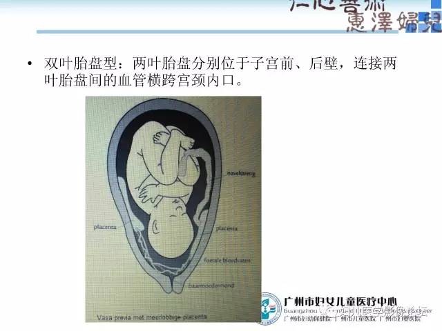 【PPT】产前胎盘植入的MR诊断