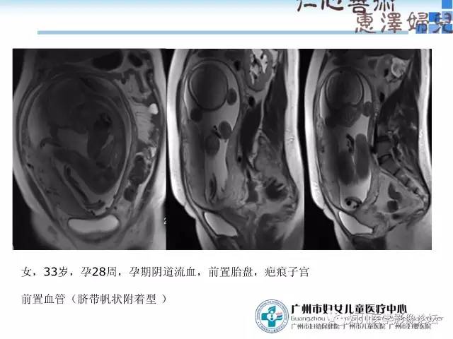 【PPT】产前胎盘植入的MR诊断