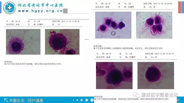 【病例】肾盂癌1例CT及MR影像表现 【病例】肾盂癌1例CT及MR影像表现