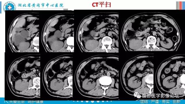 【病例】肾盂癌1例CT及MR影像表现 【病例】肾盂癌1例CT及MR影像表现