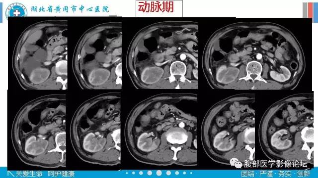 【病例】肾盂癌1例CT及MR影像表现 【病例】肾盂癌1例CT及MR影像表现
