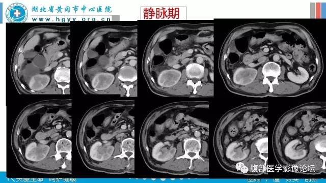 【病例】肾盂癌1例CT及MR影像表现 【病例】肾盂癌1例CT及MR影像表现